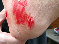my forarm with a nice scrape after a mountain biking endo